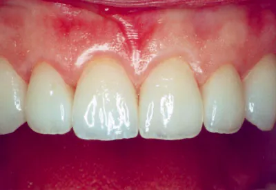 Tooth Colored Fillings