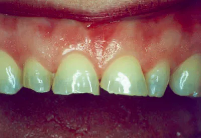 Tooth Colored Fillings