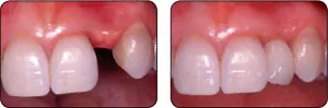 Dental Implant Procedure