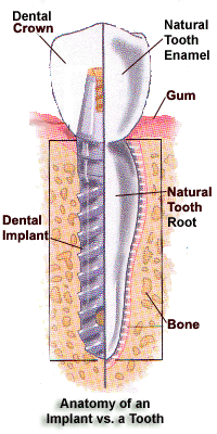 Dental Implant Procedure