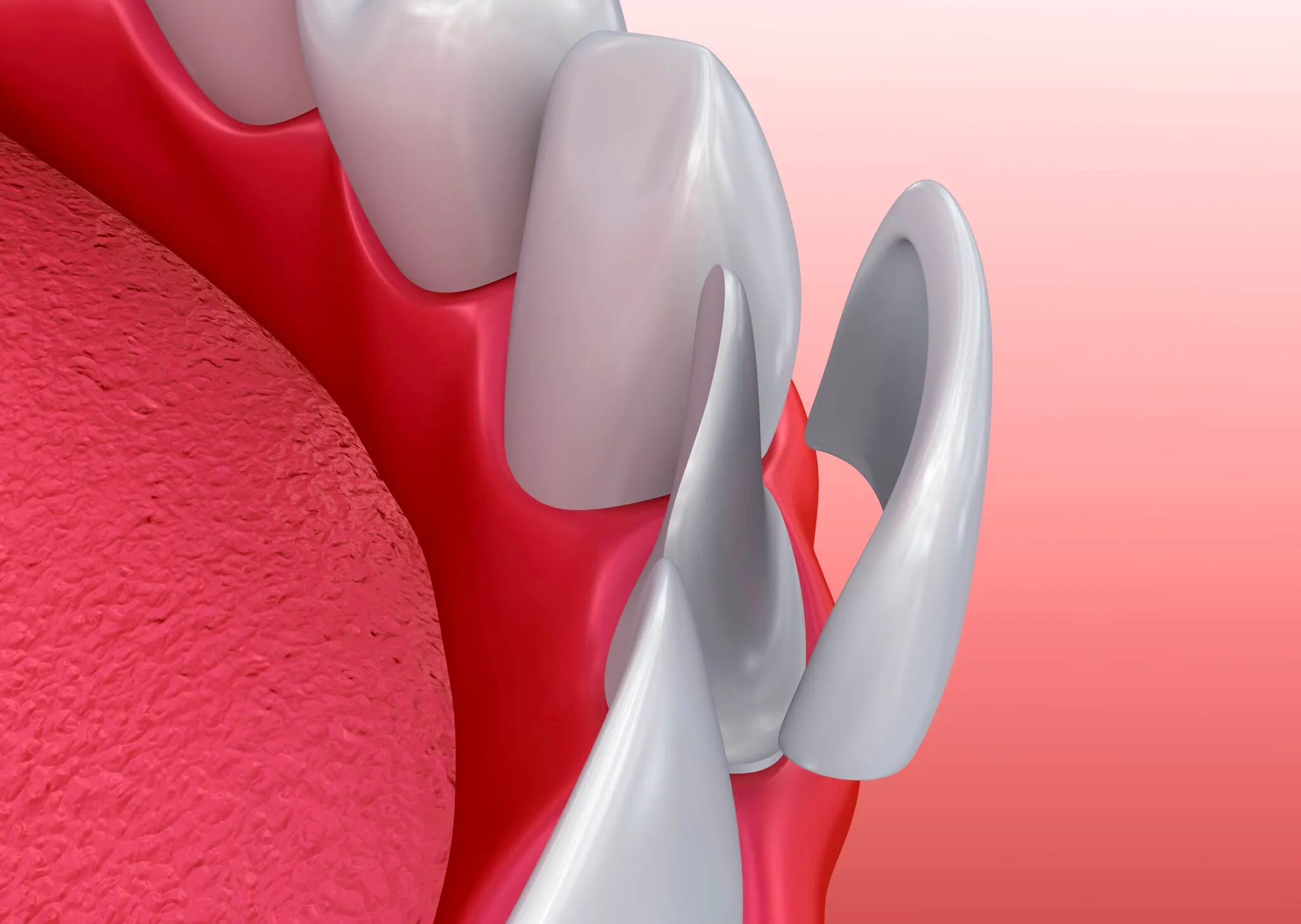 Porcelain Veneers